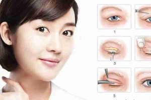 Giải đáp từ A-Z về phẫu thuật cắt mí mắt