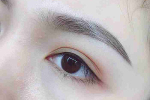 Nỗi lo cắt mí mắt ảnh hưởng đến thị lực: Đúng hay sai?