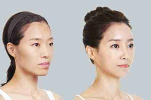 Bác sĩ giải đáp: Cấy mỡ mặt sưng lâu không?