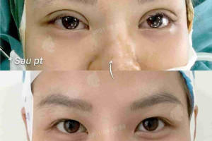 Bác sĩ nói gì: 5 lưu ý khi thực hiện cắt mí mắt?