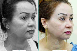 Bác sĩ giải đáp: Nâng mũi khi về già có sao không?