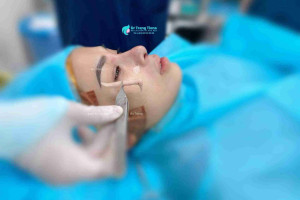 5 điều quan trọng cần biết trước khi tháo sụn nâng mũi