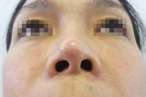 Mũi bị tụt sụn thì phải làm sao? Nguyên nhân và cách điều trị