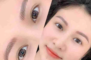 Sự thật việc cắt mí mắt để được vĩnh viễn 