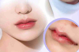 Phẫu thuật môi trái tim bao lâu thì được thoa son?