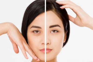 Nâng cung mày có giúp trẻ hóa mắt không?