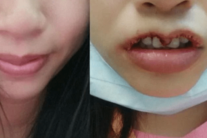 Cảnh báo biến chứng nguy hiểm cắt môi trái tim