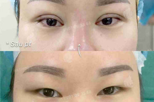 Review chi tiết cắt mắt hai mí bền đẹp tự nhiên 