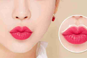 Bác sĩ giải đáp: Cắt môi trái tim bao lâu thì hết sưng đau?