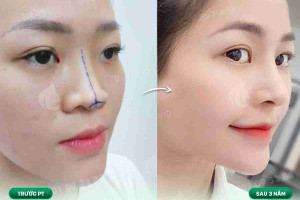 Nâng mũi sụn sườn có cần nghỉ dưỡng không?