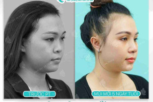 Nâng mũi sụn sườn sau một tháng đã ổn định chưa?