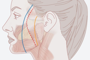 Căng da mặt toàn phần – Giải pháp trẻ hóa toàn diện