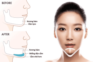 Giải đáp từ A-Z về độn cằm sụn Surgiform