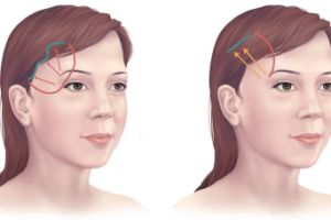 Căng da thái dương: 5 lưu ý – 5 biến chứng thường gặp