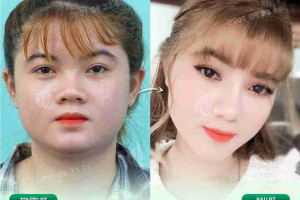 Nguyên nhân gây ra đầu mũi to mà bạn chưa biết