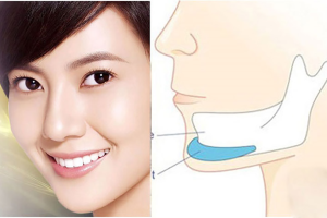 Độn cằm là gì? Thực hiện như thế nào?