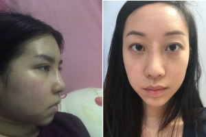 Gốc mũi quá cao sau nâng mũi có tự thấp xuống không?