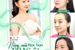 Nâng mũi hồi phục sớm 5 ngày – Nâng mũi ERAS 5i