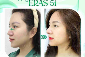 Nâng mũi ERAS 5i – Xu hướng nâng mũi 2024
