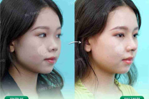 7 sự thật ít biết về nâng mũi sụn sườn