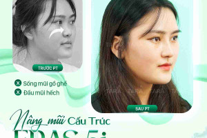 Nâng mũi cấu trúc ERAS 5i
