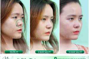 Cách hay nhất để xử lý đầu mũi bị hếch