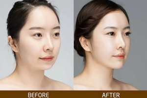 Độn cằm giá bao nhiêu? Có đắt lắm không?