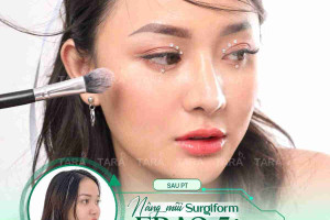 Nâng mũi ERAS 5i hồi phục sớm