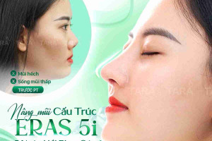 Nâng mũi hồi phục sớm 5i