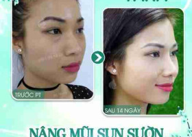 Nâng mũi sụn sườn ERAS 5i