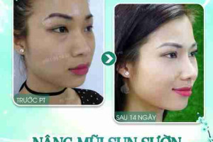 Nâng mũi sụn sườn ERAS 5i