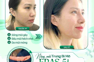 Tại sai nâng mũi ERAS 5i lại phục hồi nhanh?