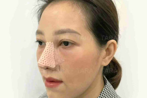 Nâng mũi ERAS 5i: Nâng mũi tháo nẹp sớm