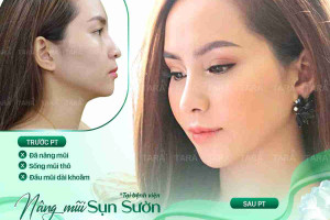 Nâng mũi sụn sườn ERAS 5i: 05 ngày phục hồi
