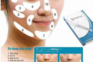 Tiêm Radiesse có tác dụng trẻ hóa như thế nào?
