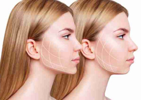 Có nên tiêm tạo hình khuôn mặt bằng filler? Ưu và nhược điểm là gì?