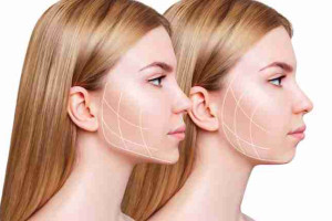 Có nên tiêm tạo hình khuôn mặt bằng filler? Ưu và nhược điểm là gì?
