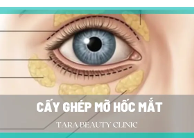 Toàn bộ thông tin về cấy mỡ tự thân hốc mắt trẻ hóa mắt