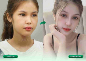 Bác sĩ giải đáp: Có nên cắt mí và nâng mũi cùng lúc?