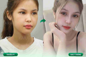 Bác sĩ giải đáp: Có nên cắt mí và nâng mũi cùng lúc?