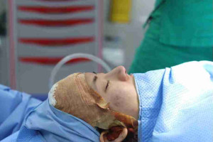 5 nguyên nhân gây mũi lộ sống? Làm sao để khắc phục?
