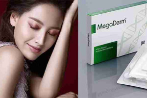 Điểm danh 4 lợi ích nâng mũi bọc sụn Megaderm