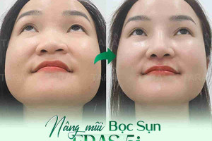 Bác sĩ giải đáp: Nâng mũi bọc sụn chỉ phù hợp với ai?