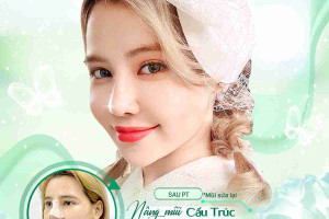 Nâng mũi hồi phục sớm 5 ngày tại Tara