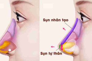 Nâng mũi cấu trúc, liệu có phải là trào lưu nhất thời?