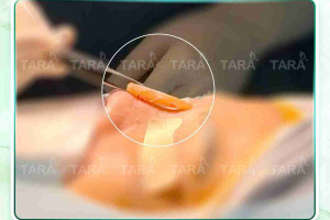 Nâng mũi sụn tự thân hay sụn nhân tạo thì đẹp nhất?