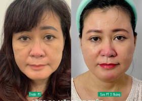 Bác sĩ phẫu thuật căng da mặt nội soi giỏi tại TPHCM