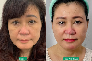 Bác sĩ phẫu thuật căng da mặt nội soi giỏi tại TPHCM