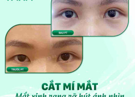 Đâu là địa chỉ cắt mí đẹp tại TPHCM