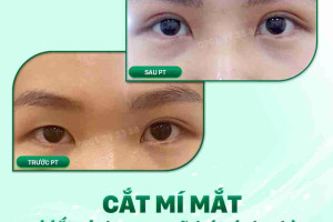 Đâu là địa chỉ cắt mí đẹp tại TPHCM